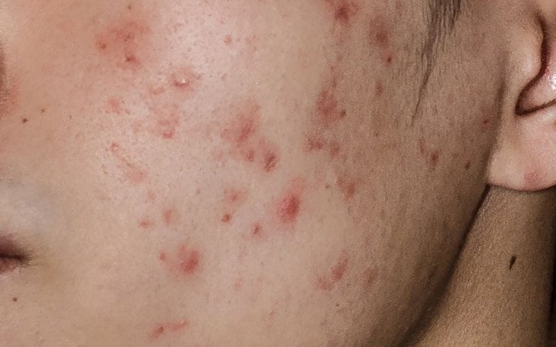 akne